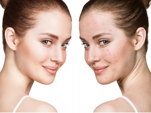 Jak dbać o cerę trądzikową? Dowiedz się jak pielęgnować skórę trądzikową?